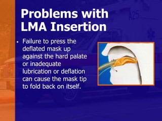 Problems with
LMA Insertion
• Failure to press the
deflated mask up
against the hard palate
or inadequate
lubrication or deflation
can cause the mask tip
to fold back on itself.
 
