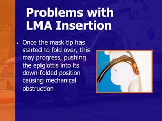 Problems with
LMA Insertion
• Once the mask tip has
started to fold over, this
may progress, pushing
the epiglottis into its
down-folded position
causing mechanical
obstruction
 