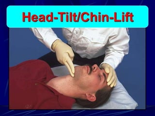 Head-tilt/chin-liftHead-Tilt/Chin-Lift
 