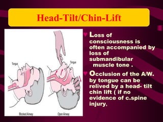 ♥ Loss of
consciousness is
often accompanied by
loss of
submandibular
muscle tone .
♥ Occlusion of the A/W.
by tongue can be
relived by a head- tilt
chin lift ( if no
evidence of c.spine
injury,
Head-Tilt/Chin-Lift
 