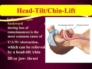 Falling of tongue
backward (
during loss of
consciousness) is the
most common cause of
U/A/W/ obstruction.
which can be relieved
by a head-tilt /chin
lift or jaw- thrust.
Head-Tilt/Chin-Lift
 