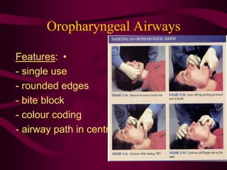 Oropharyngeal Airways
•Features:
- single use
- rounded edges
- bite block
- colour coding
- airway path in centre
 