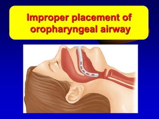OPAImproper placement of
oropharyngeal airway
 