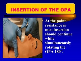INSERTION OF THE OPA :
• At the point
resistance is
met, insertion
should continue
while
simultaneously
rotating the
OPA 180°.
 