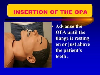 INSERTION OF THE OPA :
• Advance the
OPA until the
flange is resting
on or just above
the patient's
teeth .
 