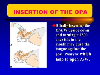 INSERTION OF THE OPA :
Blindly inserting the
O/A/W upside down
and turning it 180ْ
once it is in the
mouth may push the
tongue against the
post. Pharynx which
help to open A/W.
 