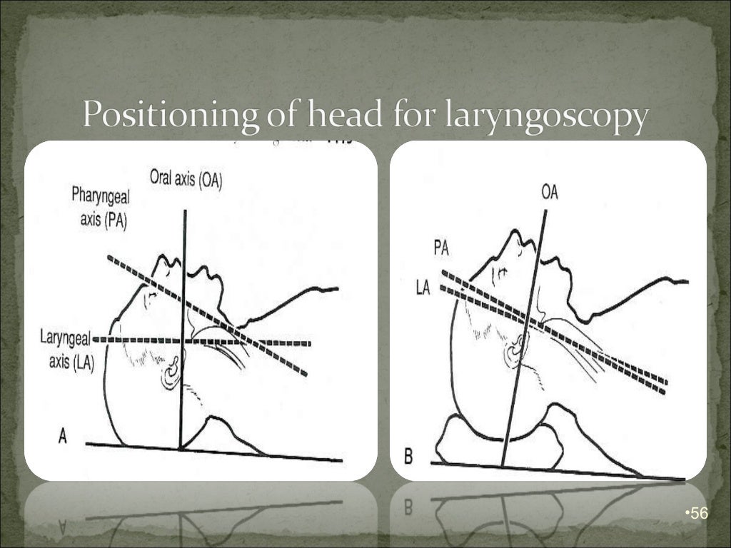 Airway management