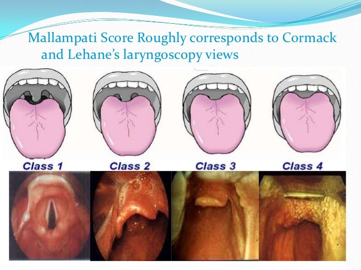 Airway management in for seadtion