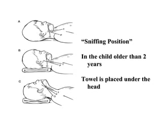 “Sniffing Position”

In the child older than 2
  years

Towel is placed under the
  head
 