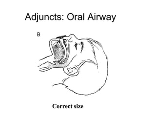 Adjuncts: Oral Airway




      Correct size
 