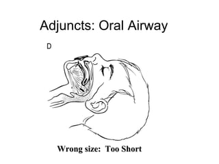 Adjuncts: Oral Airway




  Wrong size: Too Short
 