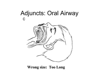 Adjuncts: Oral Airway




  Wrong size: Too Long
 
