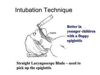 Intubation Technique

                             Better in
                             younger children
                             with a floppy
                             epiglottis




Straight Laryngoscope Blade – used to
pick up the epiglottis
 
