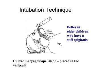 Intubation Technique

                                 Better in
                                 older children
                                 who have a
                                 stiff epiglottis




Curved Laryngoscope Blade – placed in the
vallecula
 