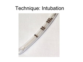 Technique: Intubation
 