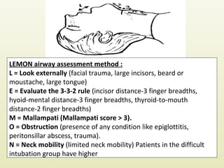 Airway management | PPT