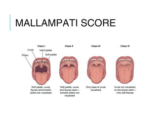 MALLAMPATI SCORE
 