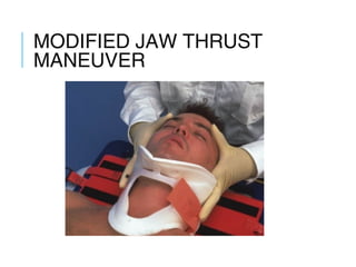 MODIFIED JAW THRUST
MANEUVER
 