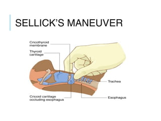 SELLICK’S MANEUVER
 