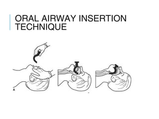 ORAL AIRWAY INSERTION
TECHNIQUE
 