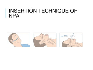 INSERTION TECHNIQUE
OF NPA
 