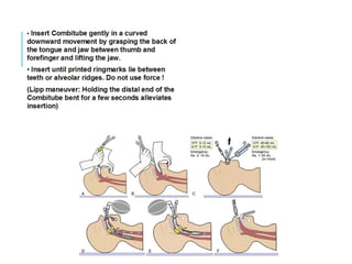 COMBITUBE INSERTION
TECHNIQUE
 