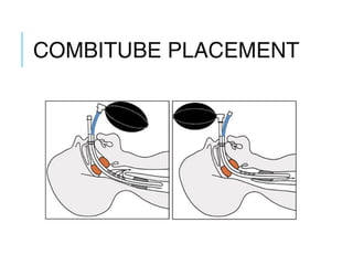 COMBITUBE PLACEMENT
 