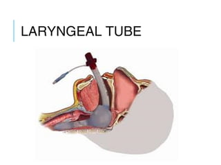 LARYNGEAL TUBE IN
PLACE
 