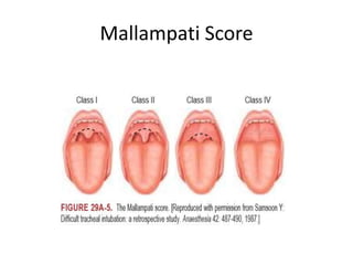 Mallampati Score
 