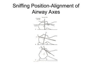 Airway Management In Anesthesia 2025 Uni of Jo | PPT