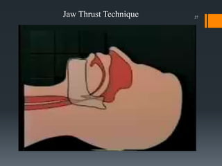 AIRWAY MANAGEMENT.pdf
