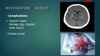 RESPIRATORY ARREST
• Complications
 Hypoxic organ
damage (eg., Hypoxic
brain injury)
• Cardiac arrest
 