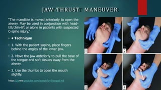 JAW -THRUST MANEUVER
“The mandible is moved anteriorly to open the
airway. May be used in conjunction with head-
tilt/chin-lift or alone in patients with suspected
C-spine injury.”
• • Technique
• 1. With the patient supine, place fingers
behind the angles of the lower jaw.
• 2. Move the jaw anteriorly to pull the base of
the tongue and soft tissues away from the
airway.
• 3. Use the thumbs to open the mouth
slightly.
https://www.youtube.com/watch?v=5iwogajl-n8
 