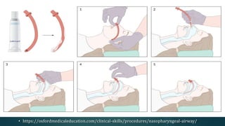 • https://oxfordmedicaleducation.com/clinical-skills/procedures/nasopharyngeal-airway/
 