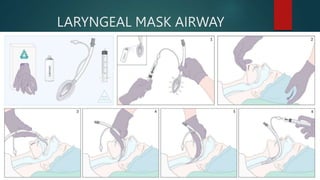 LARYNGEAL MASK AIRWAY
(LMA)
 