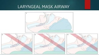 LARYNGEAL MASK AIRWAY
(LMA)
 