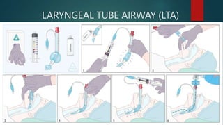 LARYNGEAL TUBE AIRWAY (LTA)
 