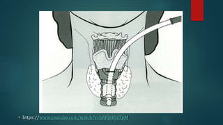 • https://www.youtube.com/watch?v=bRfQeHtv7pM
 