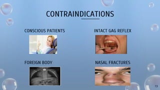 CONTRAINDICATIONS
CONSCIOUS PATIENTS
FOREIGN BODY
INTACT GAG REFLEX
NASAL FRACTURES
13
 