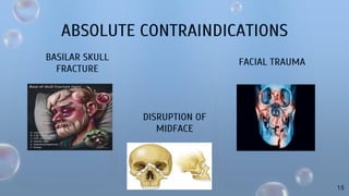 ABSOLUTE CONTRAINDICATIONS
BASILAR SKULL
FRACTURE
DISRUPTION OF
MIDFACE
FACIAL TRAUMA
15
 