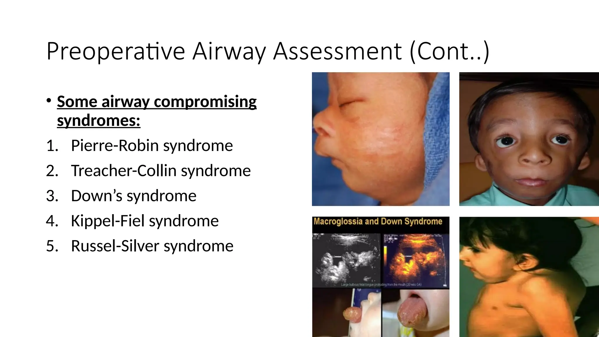 AIRWAY ANATOMY, DIFFICULT INTUBATION, Supraglotic airway devices, Video ...