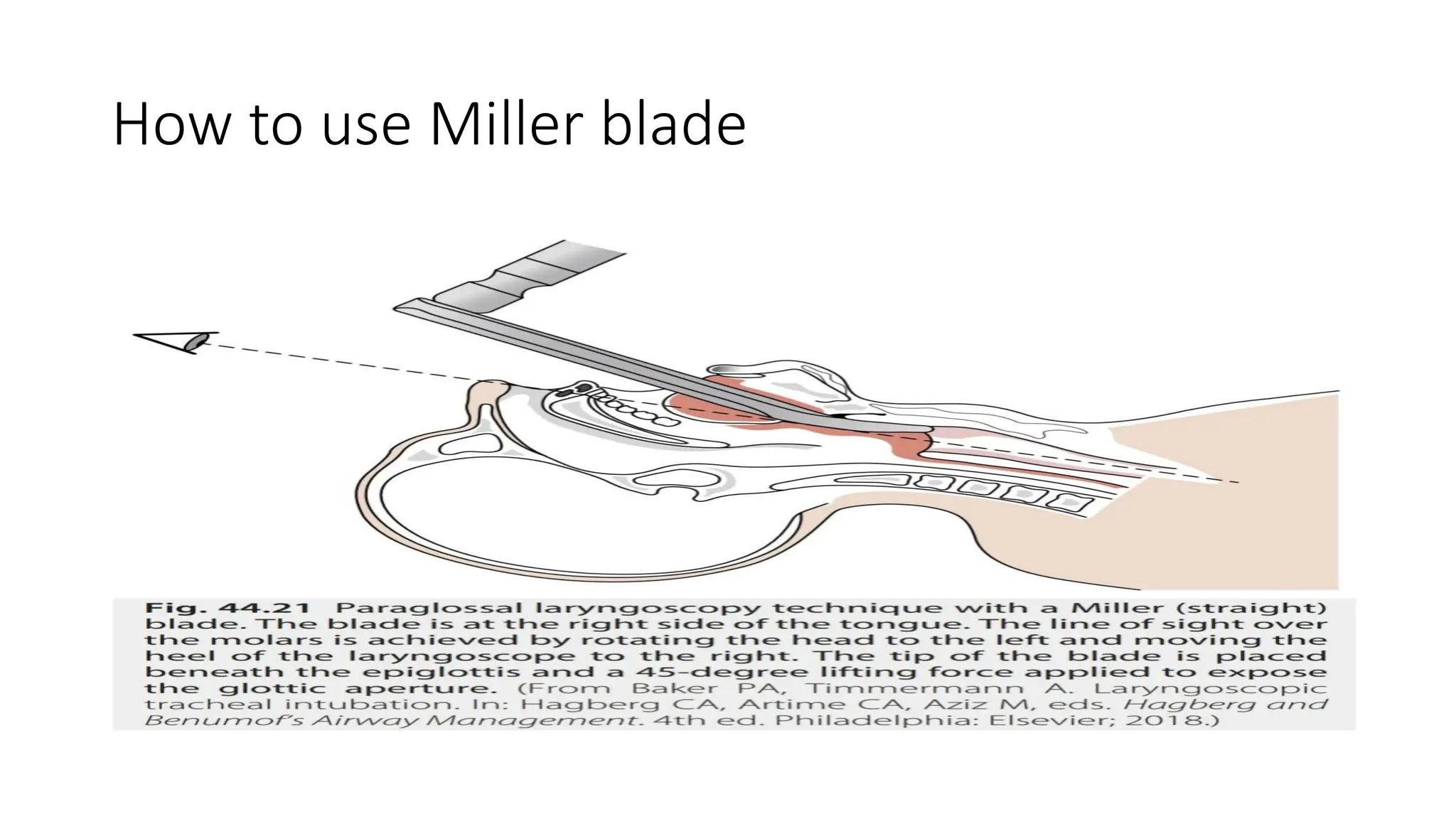 AIRWAY ANATOMY, DIFFICULT INTUBATION, Supraglotic airway devices, Video ...