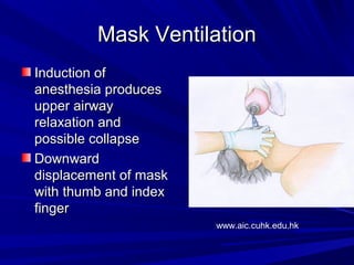 Mask VentilationMask Ventilation
Induction ofInduction of
anesthesia producesanesthesia produces
upper airwayupper airway
relaxation andrelaxation and
possible collapsepossible collapse
DownwardDownward
displacement of maskdisplacement of mask
with thumb and indexwith thumb and index
fingerfinger
www.aic.cuhk.edu.hk
 
