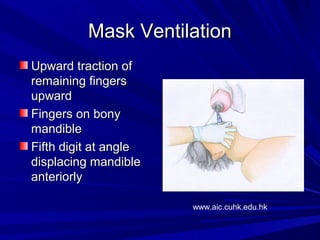 Mask VentilationMask Ventilation
Upward traction ofUpward traction of
remaining fingersremaining fingers
upwardupward
Fingers on bonyFingers on bony
mandiblemandible
Fifth digit at angleFifth digit at angle
displacing mandibledisplacing mandible
anteriorlyanteriorly
www.aic.cuhk.edu.hk
 