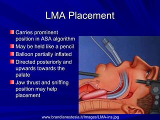 LMA PlacementLMA Placement
Carries prominentCarries prominent
position in ASA algorithmposition in ASA algorithm
May be held like a pencilMay be held like a pencil
Balloon partially inflatedBalloon partially inflated
Directed posteriorly andDirected posteriorly and
upwards towards theupwards towards the
palatepalate
Jaw thrust and sniffingJaw thrust and sniffing
position may helpposition may help
placementplacement
www.brandianestesia.it/Images/LMA-ins.jpg
 