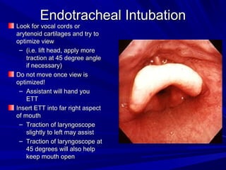Endotracheal IntubationEndotracheal Intubation
Look for vocal cords orLook for vocal cords or
arytenoid cartilages and try toarytenoid cartilages and try to
optimize viewoptimize view
– (i.e. lift head, apply more(i.e. lift head, apply more
traction at 45 degree angletraction at 45 degree angle
if necessary)if necessary)
Do not move once view isDo not move once view is
optimized!optimized!
– Assistant will hand youAssistant will hand you
ETTETT
Insert ETT into far right aspectInsert ETT into far right aspect
of mouthof mouth
– Traction of laryngoscopeTraction of laryngoscope
slightly to left may assistslightly to left may assist
– Traction of laryngoscope atTraction of laryngoscope at
45 degrees will also help45 degrees will also help
keep mouth openkeep mouth open
 