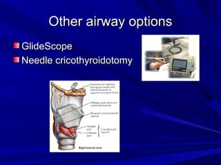 Other airway optionsOther airway options
GlideScopeGlideScope
Needle cricothyroidotomyNeedle cricothyroidotomy
 