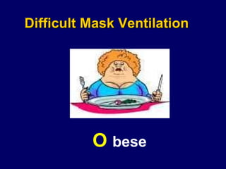 Difficult Mask Ventilation O  bese 
