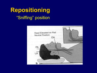 Repositioning “ Sniffing” position 