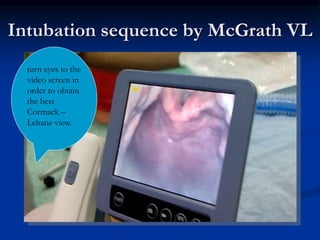 Airway management data show | PPTX